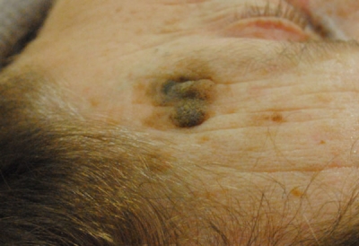 Виды и способы удаления кератомы — доброкачественной опухоли кожи