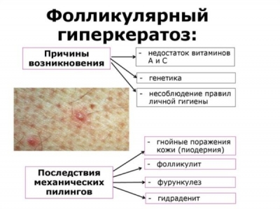 Диагностика и лечение фолликулярного кератоза у взрослых и детей