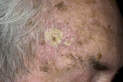Лечение актинического кератоза кожи лица
