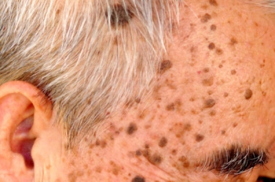 Виды и способы удаления кератомы — доброкачественной опухоли кожи