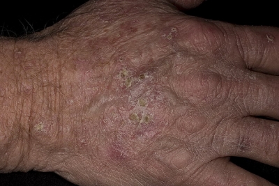 Лечение актинического кератоза кожи лица