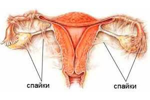 Спайки в малом тазу – что это такое и как лечить?