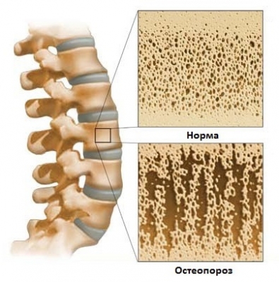 Остеопороз у женщин: симптомы, профилактика и лечение