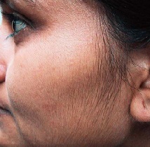 Рост волос на лице у женщин: причины и лечение с помощью различных методов