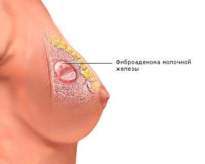 Аденома молочной железы: симптомы, диагностика и лечение