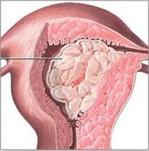 Все про гиперплазию эндометрия: симптомы, лечение, прогноз, возможность беременности