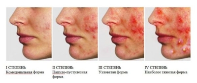 Типы гнойных прыщей на лице, причина их появления, терапия заболевания