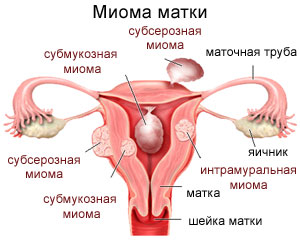Миома матки &ndash; что это такое? Симптомы и лечение
