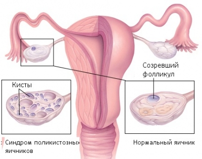 Поликистоз яичников – симптомы, причины и лечение