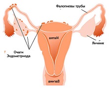 Аденомиоз матки – что это такое? Симптомы, причины и лечение