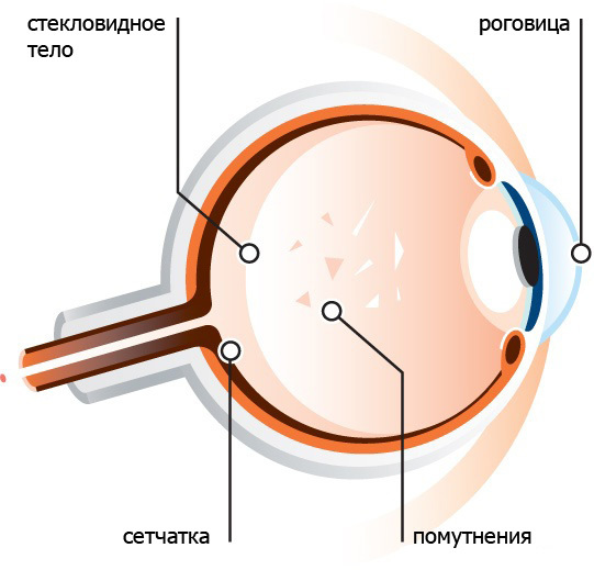 Лазерная коррекция зрения и деструкция стекловидного тела