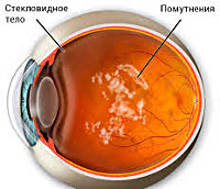 Лазерная коррекция зрения и деструкция стекловидного тела