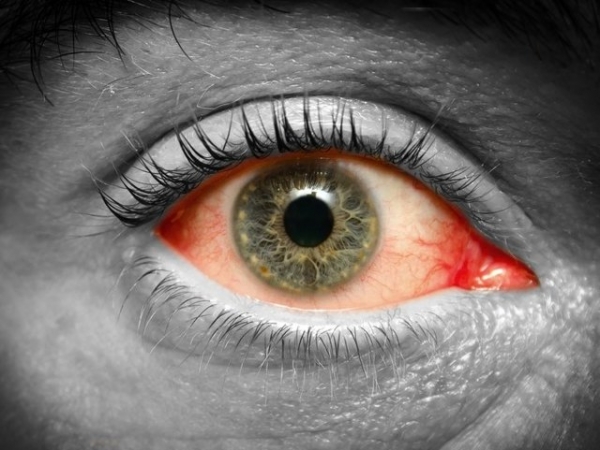Ожог сетчатки глаза — эффективные методы лечения, причины и симптомы (признаки)