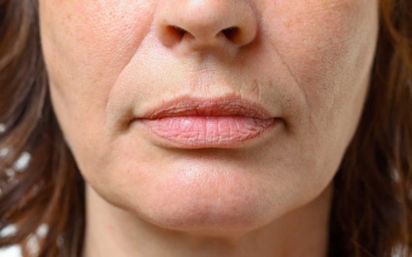 Как избавиться от морщин вокруг губ и на самих губах