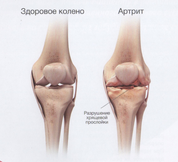 Артрит коленного сустава — симптомы и лечение, особенности
