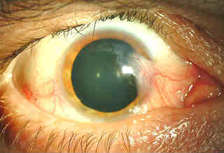 Операция по удалению птеригиума глаза — методика, отзывы и цена