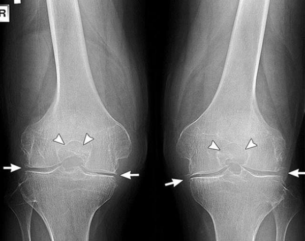 Артроз коленного сустава — способы лечения и симптомы