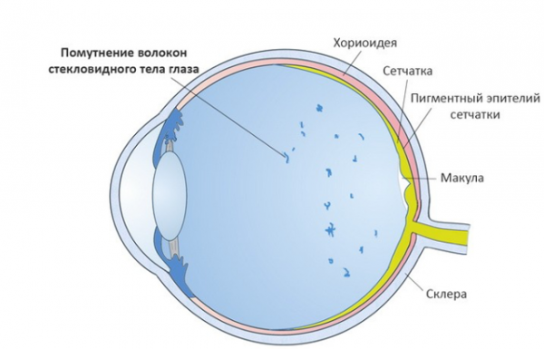 Помутнения стекловидного тела — УЗИ-исследование глаза
