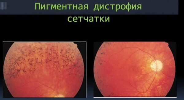 Почему появляется пелена перед глазами? Причины и лечение на сайте офтальмологического центра «МГК-Диагностик»