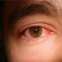 Покраснение глаз — причины и лечение на сайте офтальмологического центра «МГК-Диагностик»