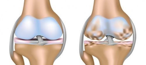 Гонартроз коленного сустава — что это, симптомы и лечение