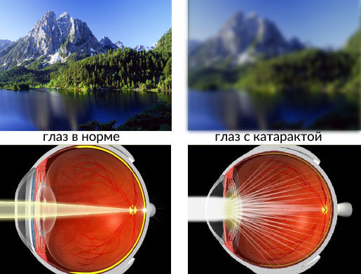 Признаки и симпломы начальной стадии катаракты — диагностика и лечение