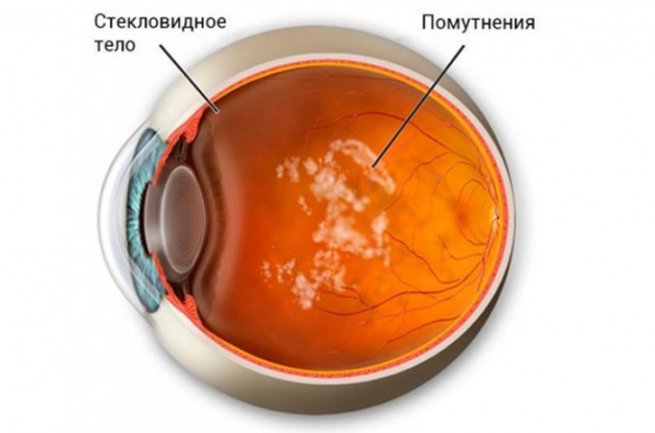 Почему развивается помутнение (деструкция) стекловидного тела глаза и способы лечения патологии