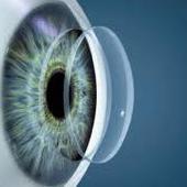 После пересадки роговицы глаза (кератопластики): что можно и что нельзя делать пациенту