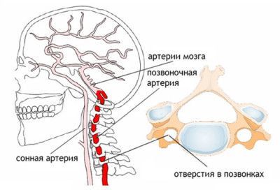 Головная боль при остеохондрозе шейного отдела — симптомы и лечение
