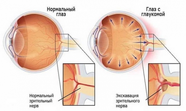 Болезни глаз у человека — названия, полный список