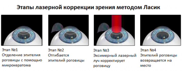 Тонкая роговица и лазерная коррекция зрения