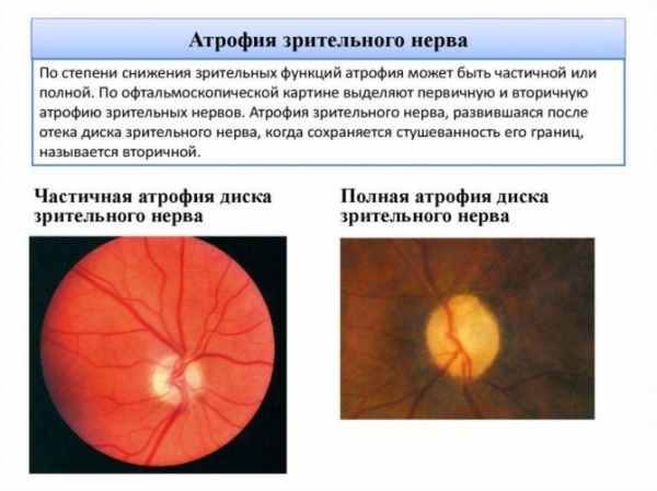 Что такое неврит зрительного нерва, почему он возникает и как его лечить?