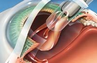 Ультразвуковая факоэмульсификация — операция по удалению катаракты