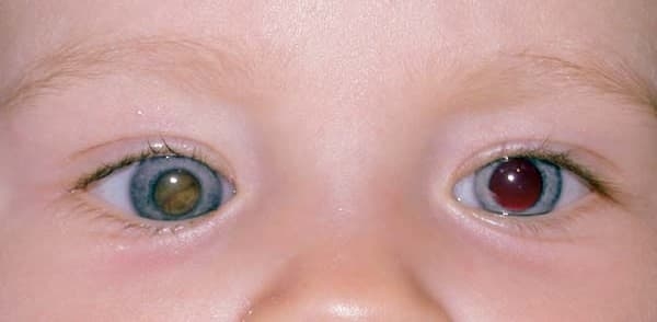 Рак глаза у детей и взрослых: первые симптомы, причины, фото и лечение