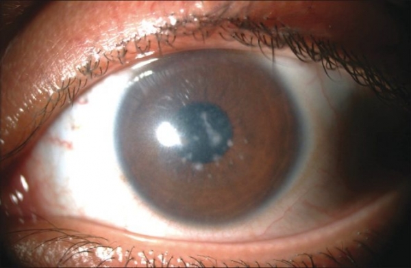 Васкуляризованное бельмо роговицы на фоне нистагма и другой патологии глаз
