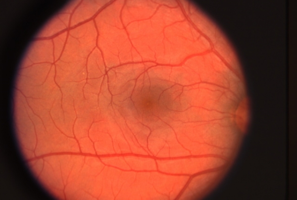 Хориоретинит с кровоизлиянием в сетчатку — как восстановить зрение