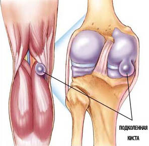 Киста Бейкера коленного сустава — симптомы и лечение, что это