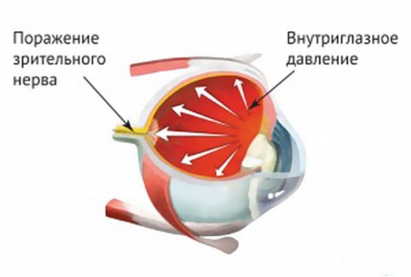 Цены на лечение глаукомы в Московском офтальмологическом центре