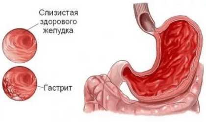 Можно ли куриный или овощной бульон при отравлении — готовим вместе Можно ли куриный или овощной бульон при отравлении — готовим вместе